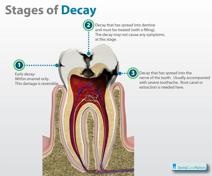 signs of tooth decay