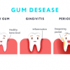 gum disease explanation